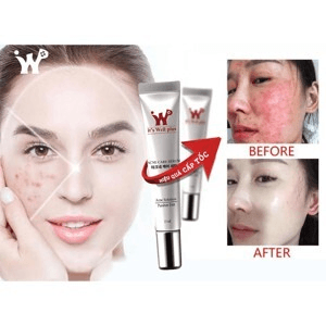 Ảnh Serum đặc trị mụn tận gốc và làm đầy sẹo Acne Care Serum