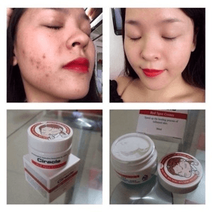 Ảnh Kem đặc trị thâm mụn Ciracle Red spot Cream 30ml